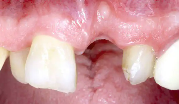 Image for case report Guided bone regeneration using layering technique in the aesthetic zone
