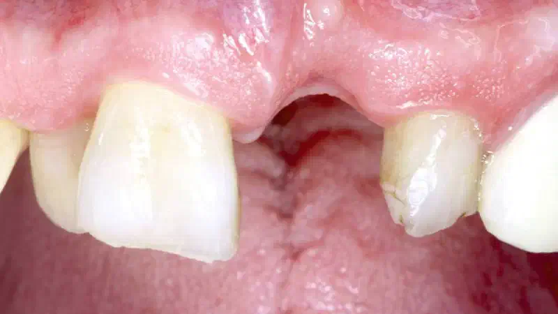 Guided bone regeneration using layering technique in the aesthetic zone