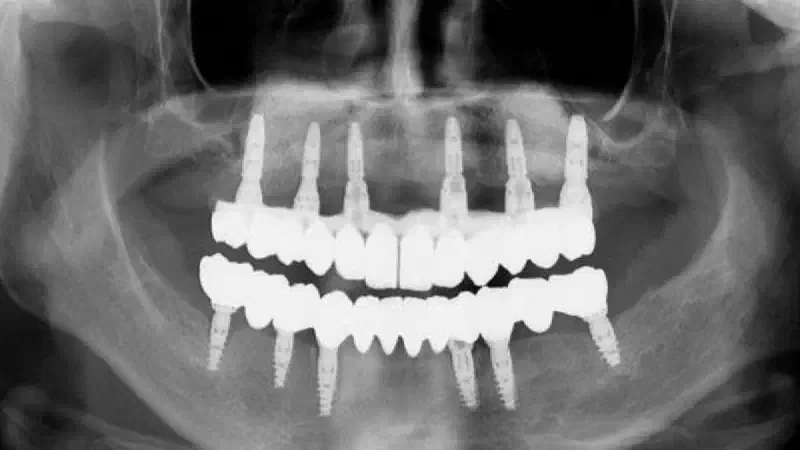Regeneration of Horizontal Bone Defect in Edentulous Maxilla Using the Allogenic Bone-Plate Shell Technique and a Composite Bone Graft – A Case Report
