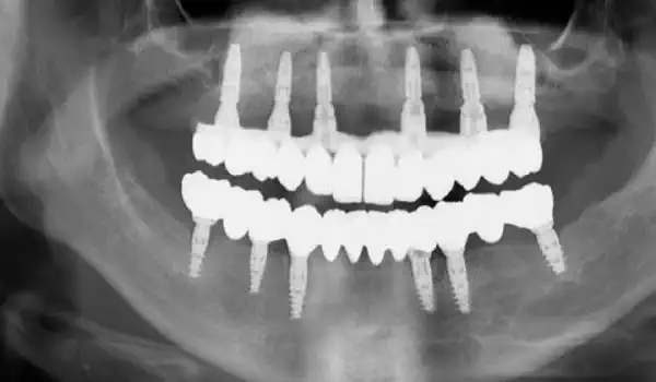 Image for case report Regeneration of Horizontal Bone Defect in Edentulous Maxilla Using the Allogenic Bone-Plate Shell Technique and a Composite Bone Graft – A Case Report