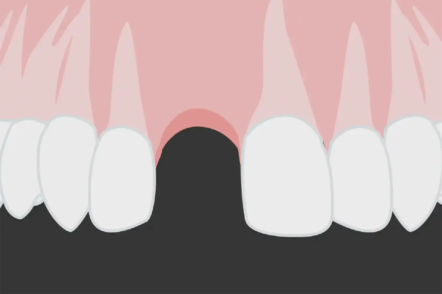 Immediate implant placement vs. early implant treatment in the esthetic area. A 1-year randomized clinical trial