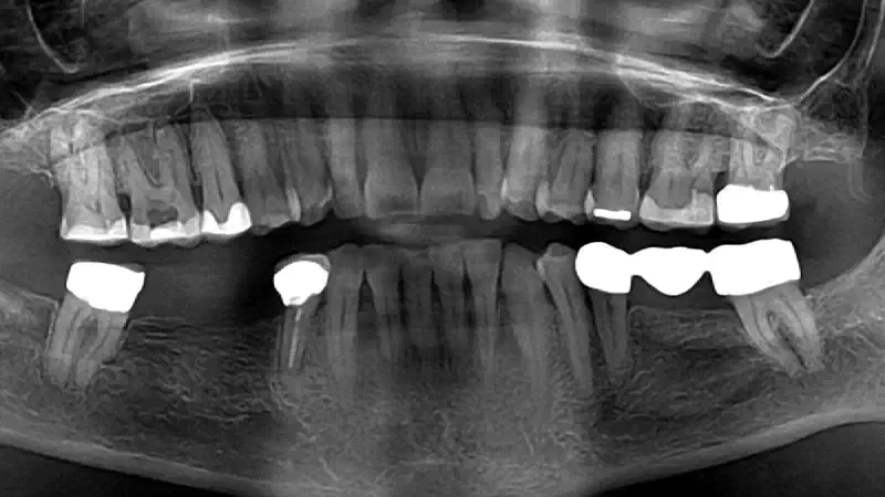 Predictable horizontal ridge augmentation and soft tissue thickening using an allogenic bone strut and a porcine collagen membrane