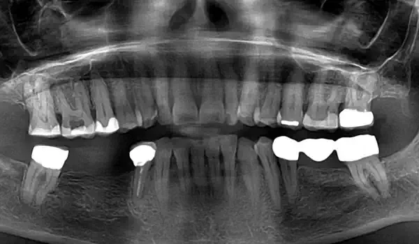 Image for case report Predictable horizontal ridge augmentation and soft tissue thickening using an allogenic bone strut and a porcine collagen membrane