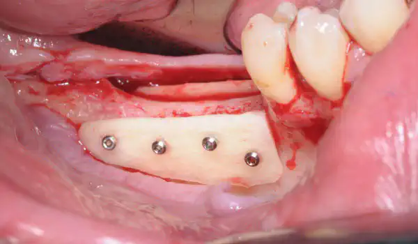 Image for case report Three-dimensional augmentation with maxgraft® cortico