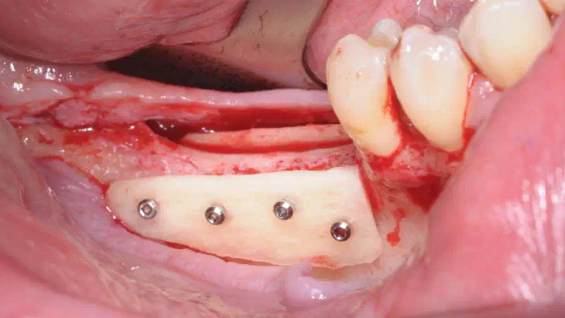 Three-dimensional augmentation with maxgraft® cortico