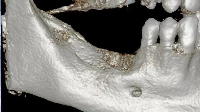 Dreidimensionale allogene Knochenaugmentation in Schalentechnik