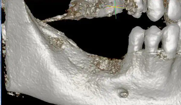 Image for case report Dreidimensionale allogene Knochenaugmentation in Schalentechnik