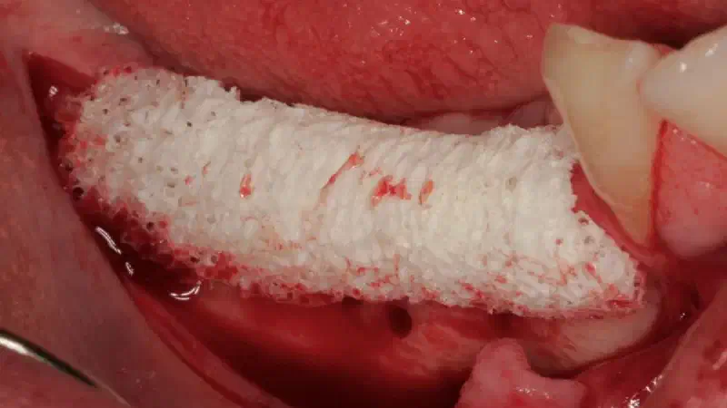 Horizontal ridge augmentation and implantation in the mandible using a Customized Allogenic Bone Block with BLX implants