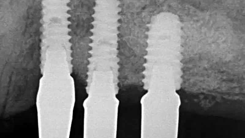 Reconstruction of the posterior maxilla using cerabone® +HyA – A case report