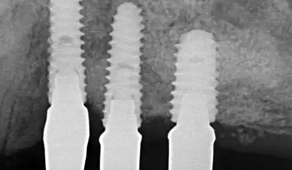 Image for case report Reconstruction of the posterior maxilla using cerabone® +HyA – A case report