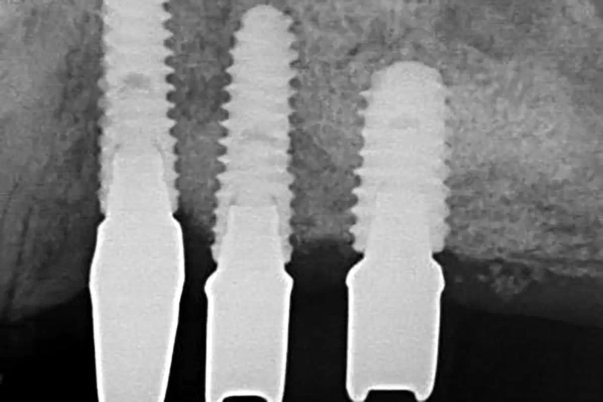 Reconstruction of the posterior maxilla using cerabone® +HyA – A case report