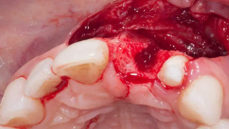 Augmentation with maxgraft® cortico – Dr. K. Chmielewski