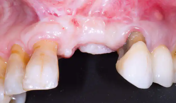 Image for case GBR with cerabone® and Jason® membrane using the Sausage Technique