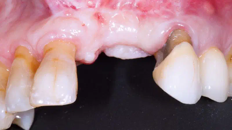 GBR with cerabone® and Jason® membrane using the Sausage Technique