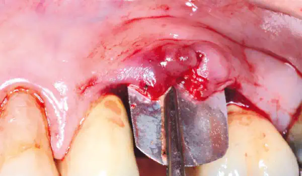 Image for case Initial findings from a Shield Technique study in collaboration with the Faculty of Dental Medicine, Lebanese University Lebanon University – Immediate implant placement