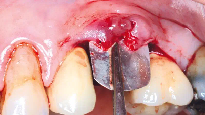 Initial findings from a Shield Technique study in collaboration with the Faculty of Dental Medicine, Lebanese University Lebanon University – Immediate implant placement