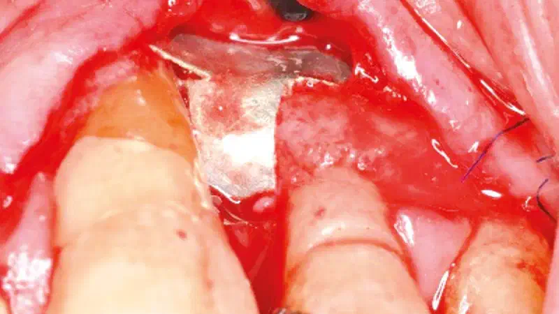 Treatment of combined horizontal and vertical intrabony defect using NOVAMag® membrane and cerabone®
