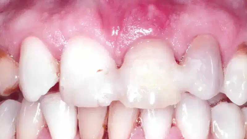Immediate implant placement and ridge preservation in the aesthetic zone using cerabone® and Jason® membrane