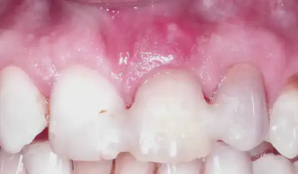 Image for case Immediate implant placement and ridge preservation in the aesthetic zone using cerabone® and Jason® membrane
