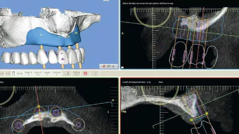 Full arch reconstruction of the maxilla with maxgraft® bonebuilder