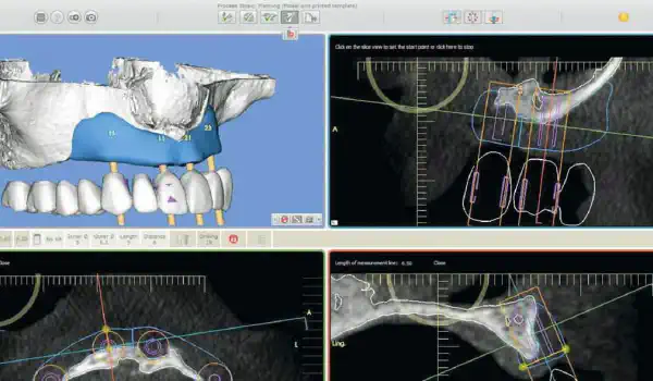 Image for case Full arch reconstruction of the maxilla with maxgraft® bonebuilder
