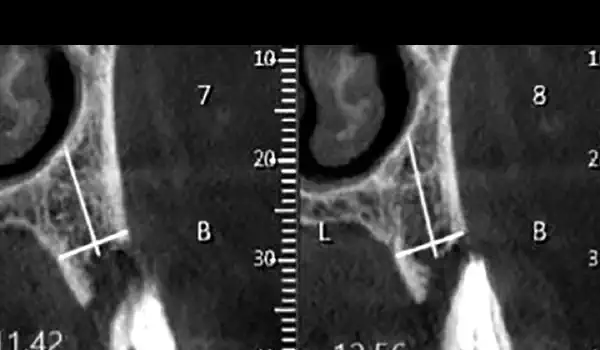 Image for case Simultaneous buccal and palatal alveolar ridge reconstruction using biodegradable magnesium membrane shield technique