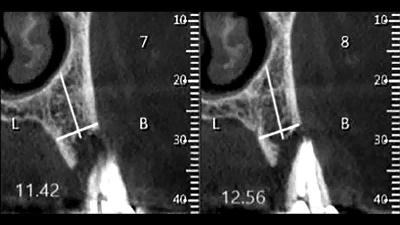 Simultaneous buccal and palatal alveolar ridge reconstruction using biodegradable magnesium membrane shield technique
