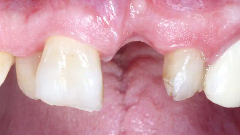 GBR using layering technique in aesthetic zone with maxgraft® and cerabone®
