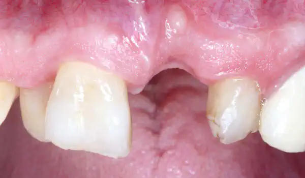 Image for case GBR using layering technique in aesthetic zone with maxgraft® and cerabone®
