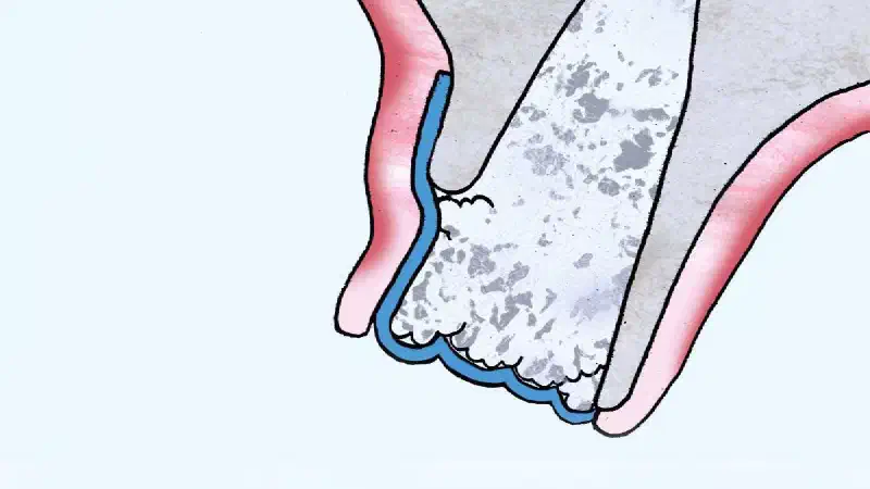 Tunneling approach using permamem® for socket preservation