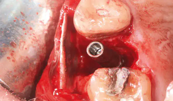 Image for case Double layer magnesium membrane shield technique for buccal wall reconstruction