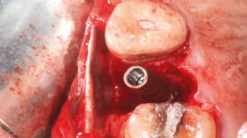 Double layer magnesium membrane shield technique for buccal wall reconstruction