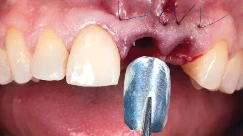 Immediate Implant Placement with Simultaneous Labial Wall Reconstruction Using NOVAMag® SHIELD and Socket Grafting with cerabone® +HyA in the Aesthetic Zone