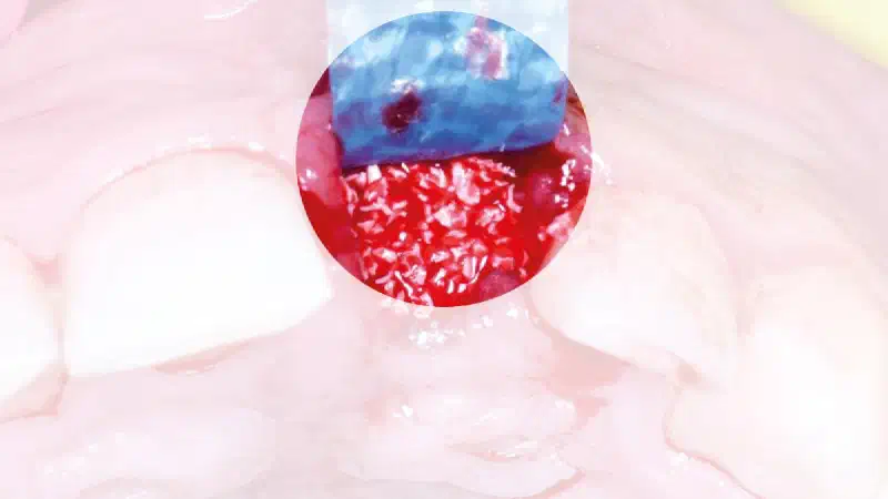Ridge preservation in the aesthetic zone using cerabone®, permamem® and collprotect® membrane