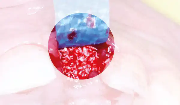 Image for case Ridge preservation in the aesthetic zone using cerabone®, permamem® and collprotect® membrane