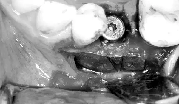 Image for case Shield Technique in a case with immediate implant placement