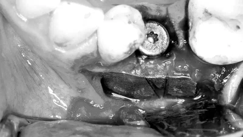 Shield Technique in a case with immediate implant placement