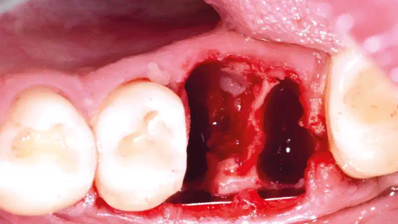 Alveolar ridge preservation with the Shield technique in the mandibula