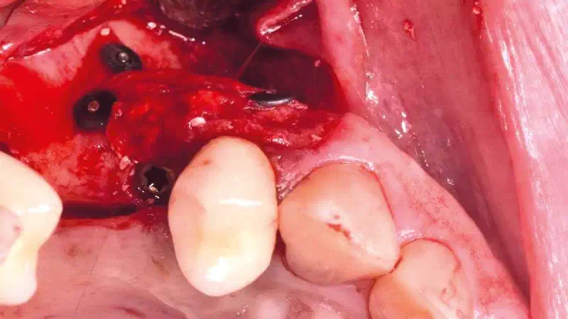 Ridge augmentation in the maxilla with Jason® membrane and NOVAMag® fixation screws