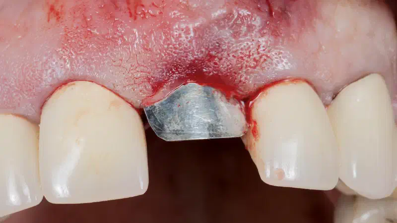 Immediate Implant Placement Using NOVAMag® SHIELD and maxgraft® in the Aesthetic Zone