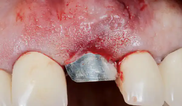 Image for case Immediate Implant Placement Using NOVAMag® SHIELD and maxgraft® in the Aesthetic Zone