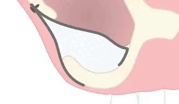 Image for case Resorbable magnesium metal membrane for a sinus lift procedure – application of the NOVAMag® membrane