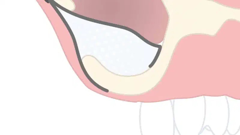 Resorbable magnesium metal membrane for a sinus lift procedure – application of the NOVAMag® membrane