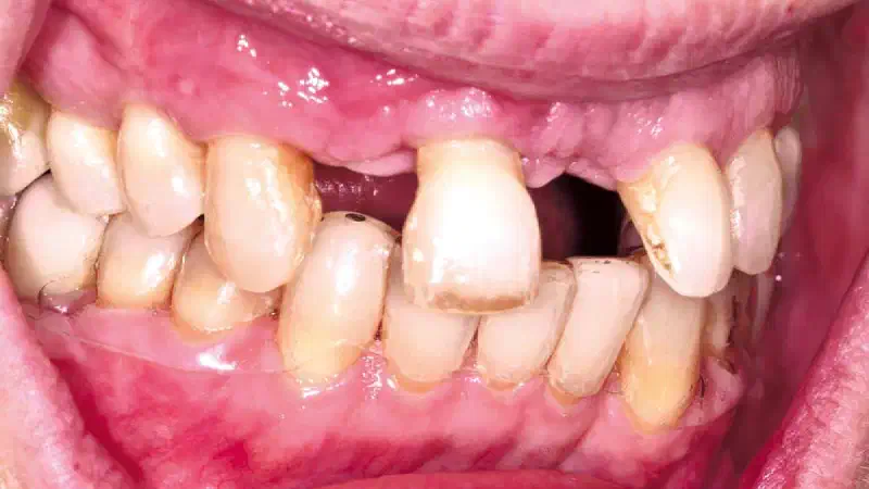 Resorbable magnesium membranes and fixation screws for GBR in delayed implant placement