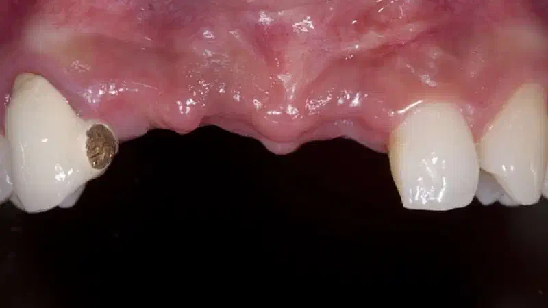 Block augmentation with maxgraft® block & mucoderm®