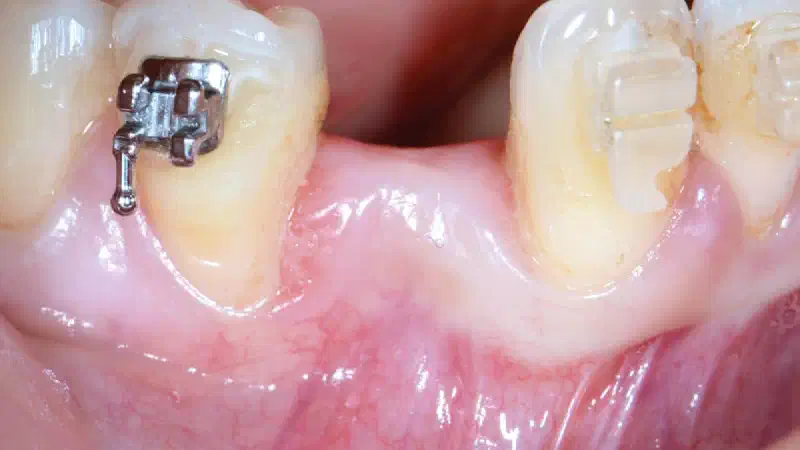 Implant placement and horizontal GBR in the posterior mandible