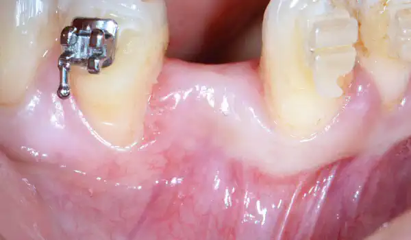Image for case Implant placement and horizontal GBR in the posterior mandible