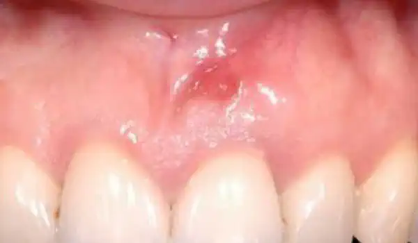 Image for case GBR together with soft tissue augmentation with mucoderm® and maxresorb®