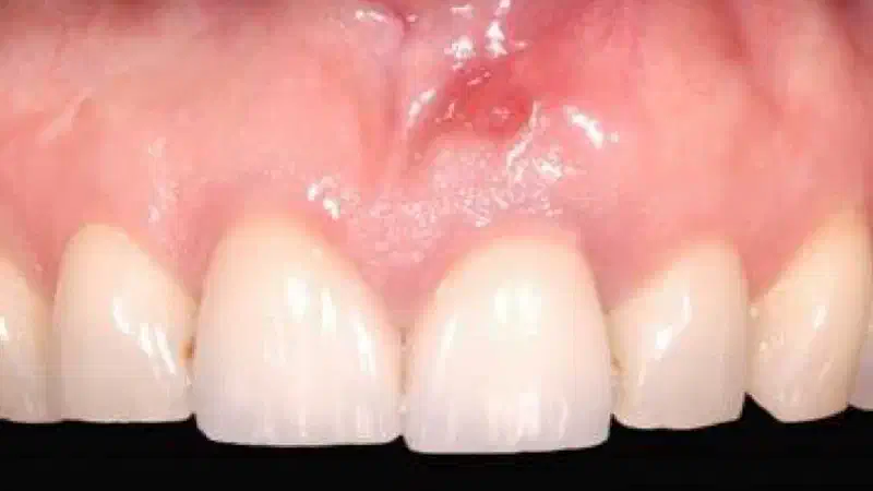 GBR together with soft tissue augmentation with mucoderm® and maxresorb®