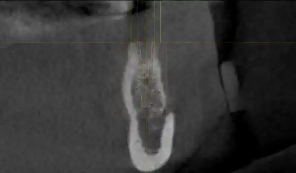 Image for case GBR with maxresorb® & collprotect® membrane